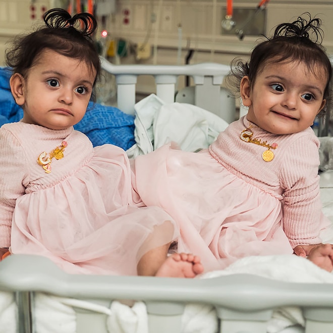 Conjoined Twins Connected at Pelvis Separated After 18-Hour Surgery